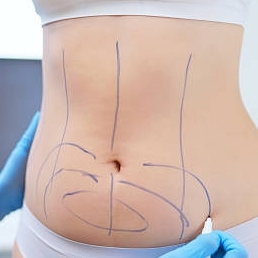 Liposuction In Riyadh