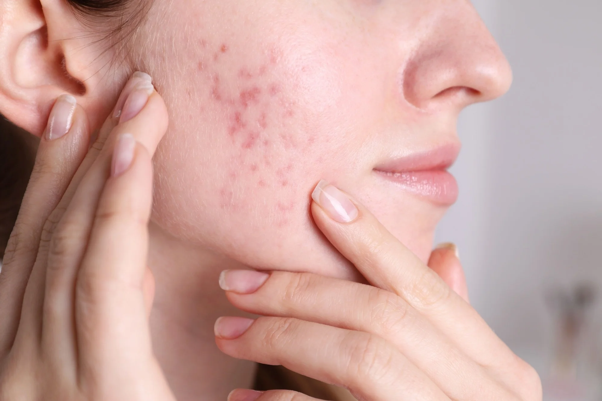 What is Isotroin 10, and how does it work to treat acne?