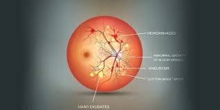 Diabetic Retinopathy Diagnostics Market Research (2025&ndash;2034): Industry Structure and Growth