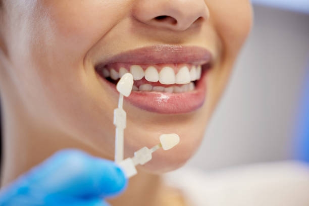  Common Mistakes Patients Make After Treatment Dental Veneers in Pakistan: