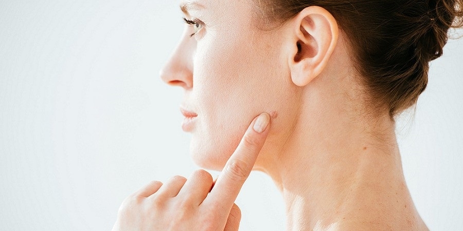 Can Mole Removal Improve Facial Confidence?