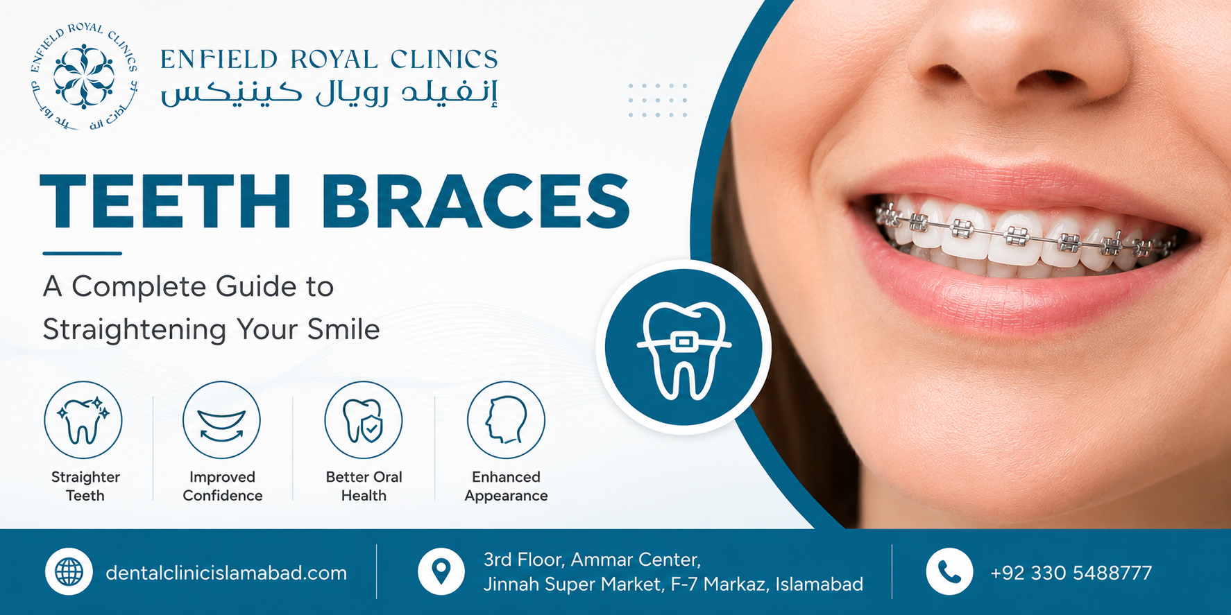 Why Teeth Braces in Islamabad Pakistan Help Prevent Future Dental Problems