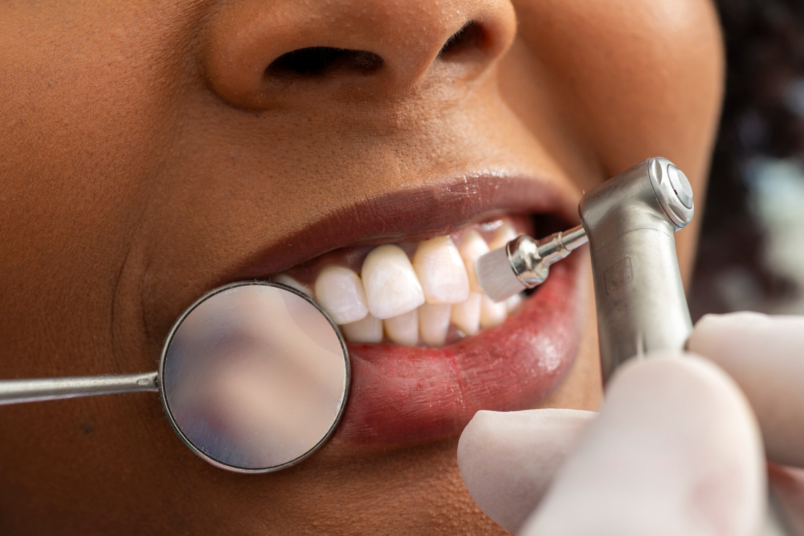 Best Teeth Whitening in Abu Dhabi: Achieve a Brighter, More Confident Smile