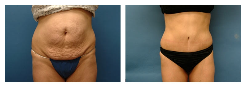 Tummy Tuck Surgery in Dubai for Body Shape Enhancement