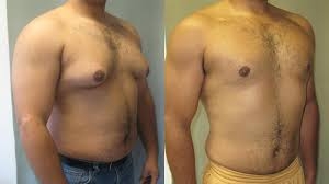 Gynaecomastia Surgery in Dubai: Recovery Tips