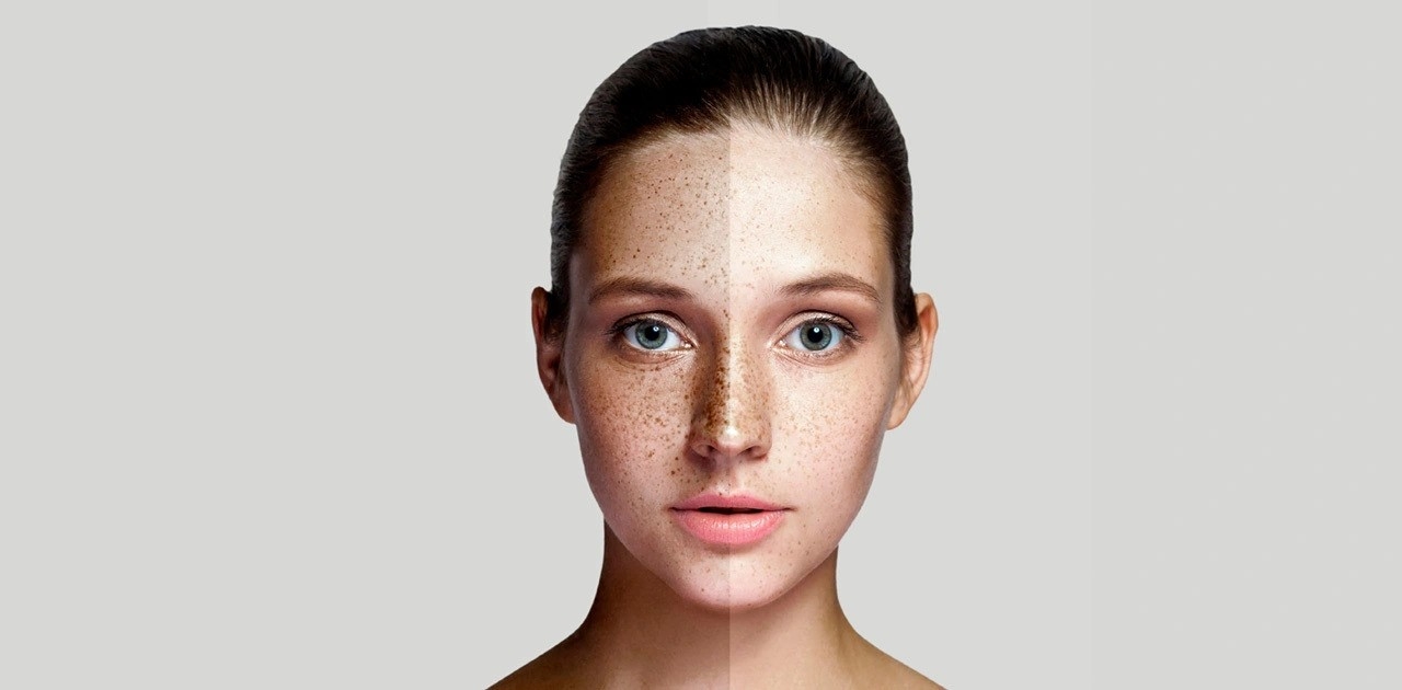 Improve Skin with Melasma Therapy