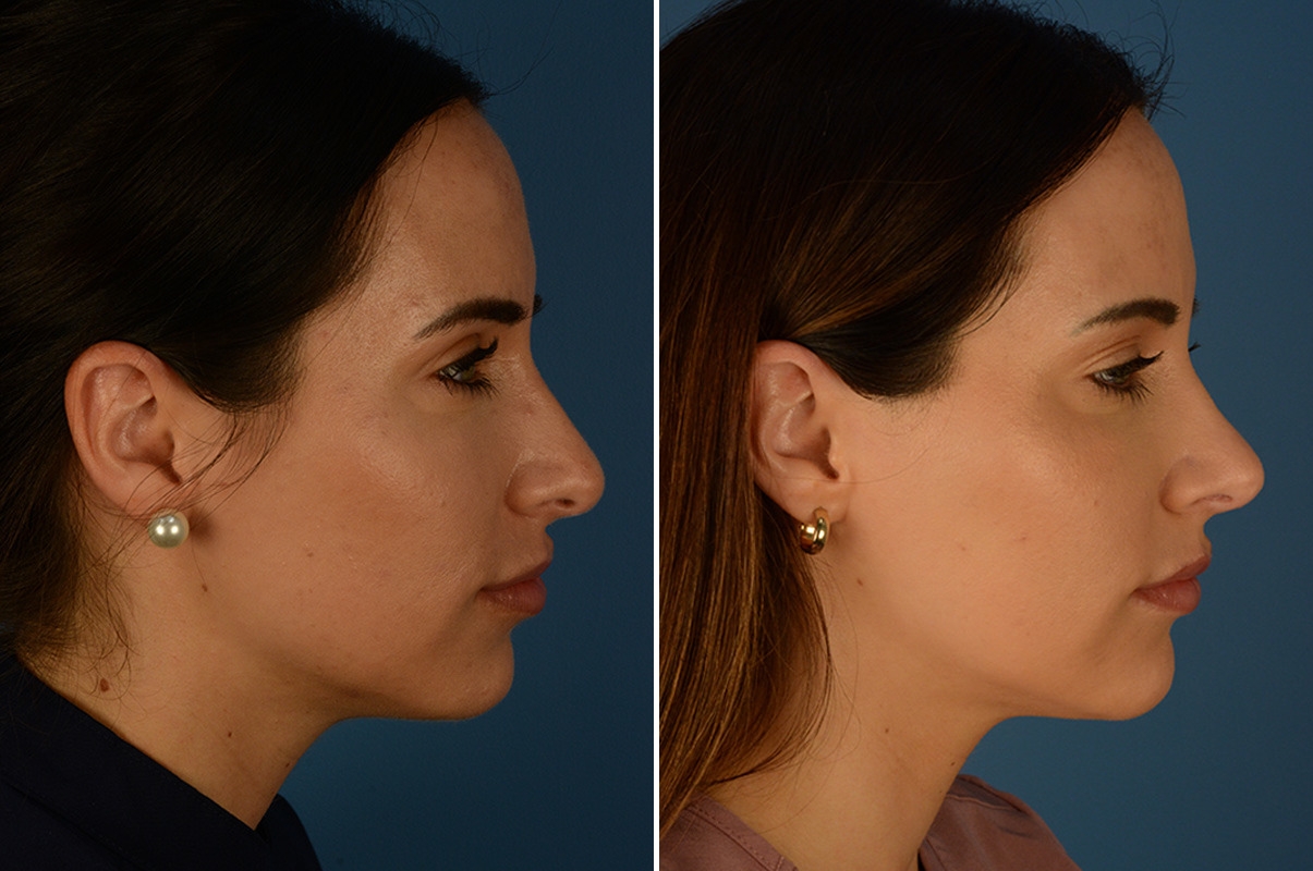 Rhinoplasty in Dubai Structural Nose Correction Guide