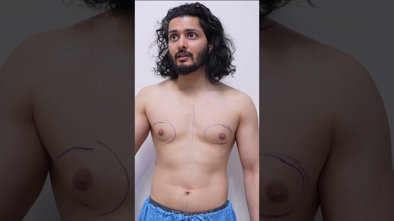 Gynaecomastia surgery in Dubai Treatment Overview
