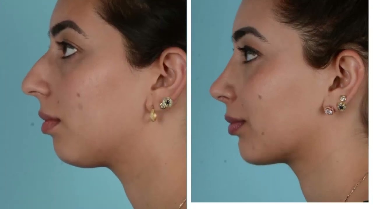 Kybella Treatment for Double Chin in Dubai Results