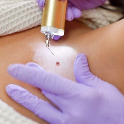Mole Removal in Dubai: Healing Time Explained Guide