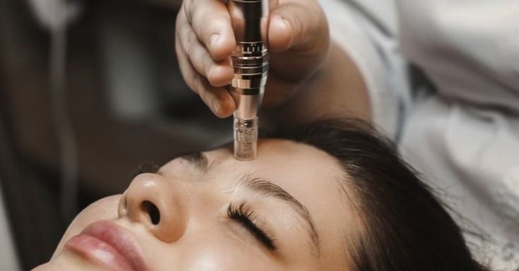 Microneedling with PRP in Dubai for Skin Glow